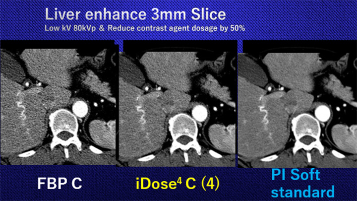 Philips CT AI セミナー 講演資料 1