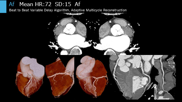 Philips CT AI セミナー 講演資料 2