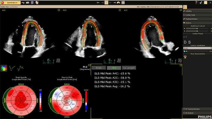 AutoStrain LVの画像
