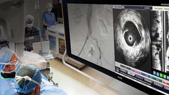 末梢血管イメージングカテーテル