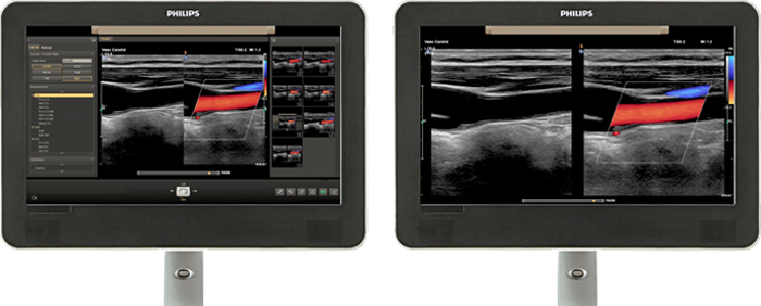 血管超音波画像の表示領域の比較 image