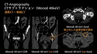 Spectral CT クリニカル・ケース case84