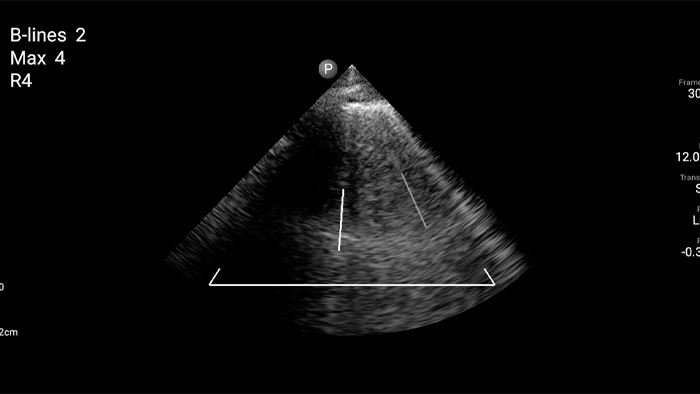 B-Line カウンティング機能