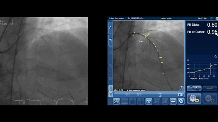 iFR コレジストレーションワークフローのビデオ