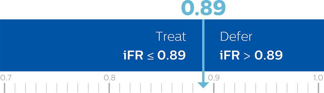 iFR カットポイント