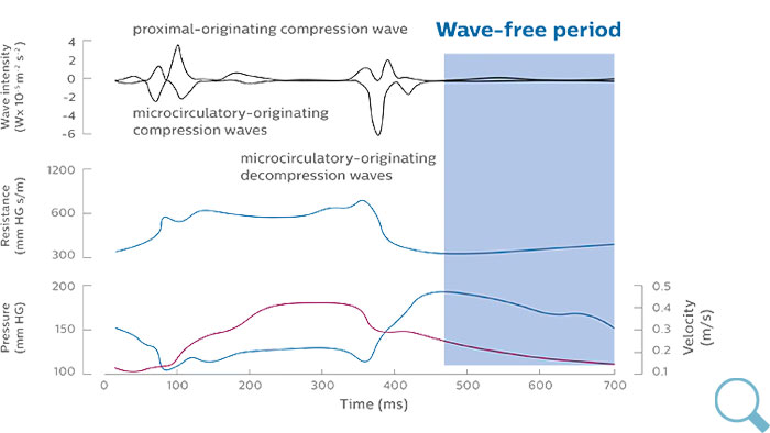 iFR wave-free period のダウンロード画像