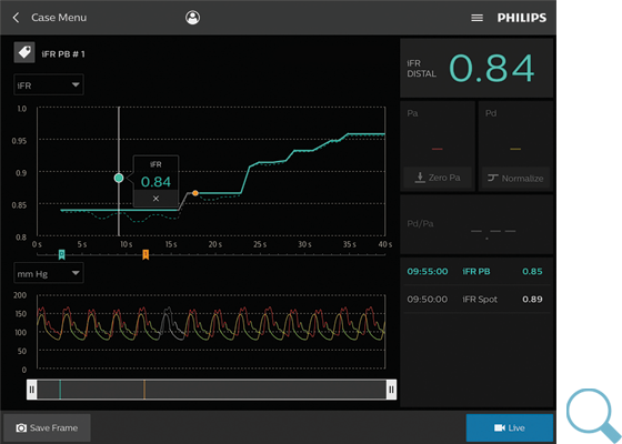 IntraSight iFR のダウンロード画像