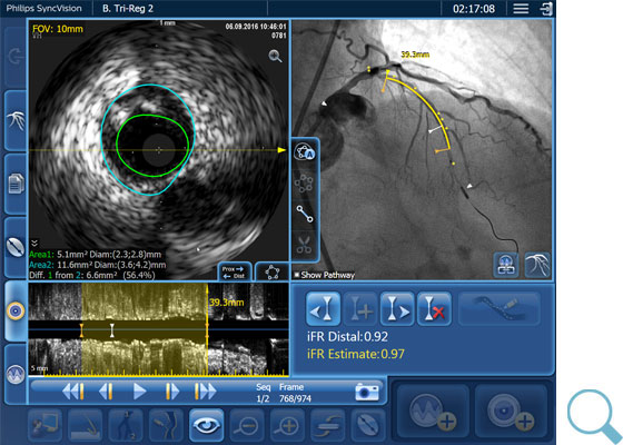 iFR トリレジストレーションのダウンロード画像