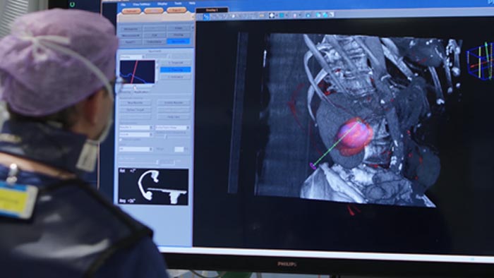 腫瘍の生検とアブレーション