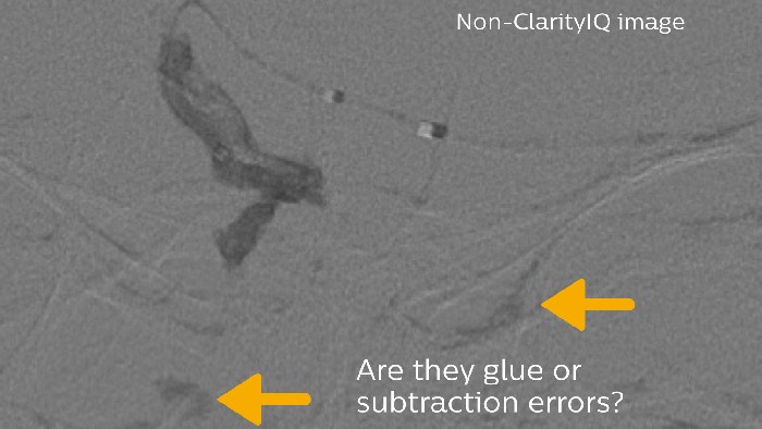 グルーとサブトラクションエラー