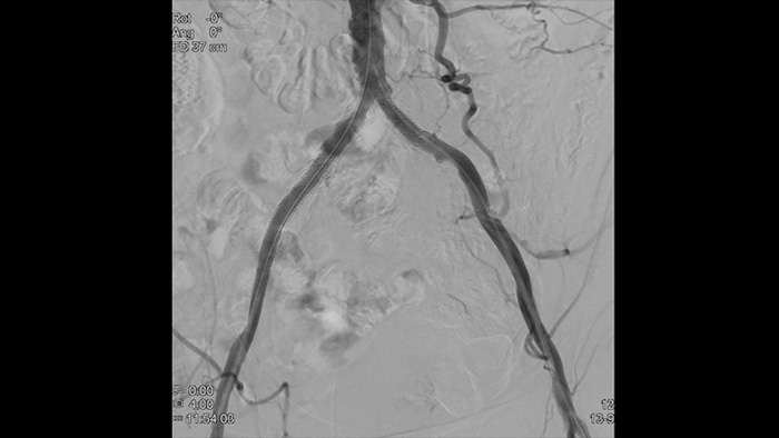 ClarityIQを使用した2D DSA