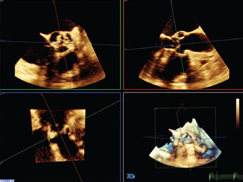 SHDインターベンション　ソリューション image