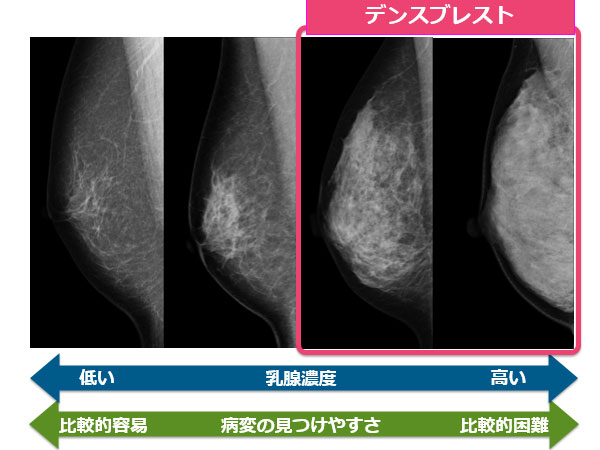 マンモグラフィでがんを見つけにくい乳房